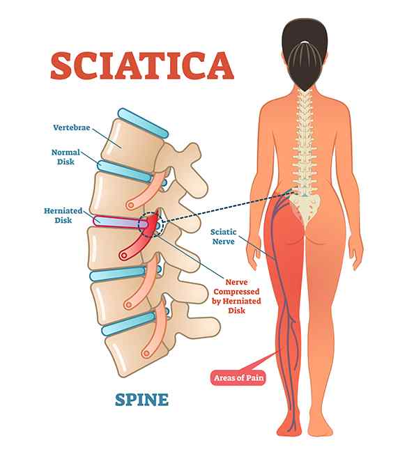 Lower spine and sciatic nerve pain in leg. Backbone diagram with vertebrae, disks and nerves. Full woman patient body from back.